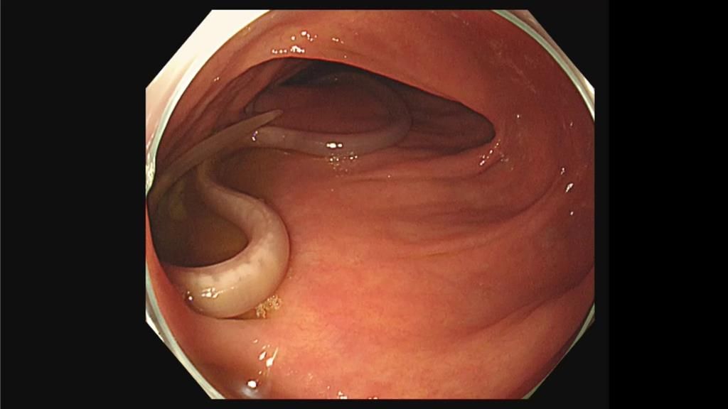 大腸鏡檢查，赫然在患者乙狀結腸發現兩條白色蠕蟲不停蠕動。（大林慈濟醫院提供／呂妍庭嘉義傳真）