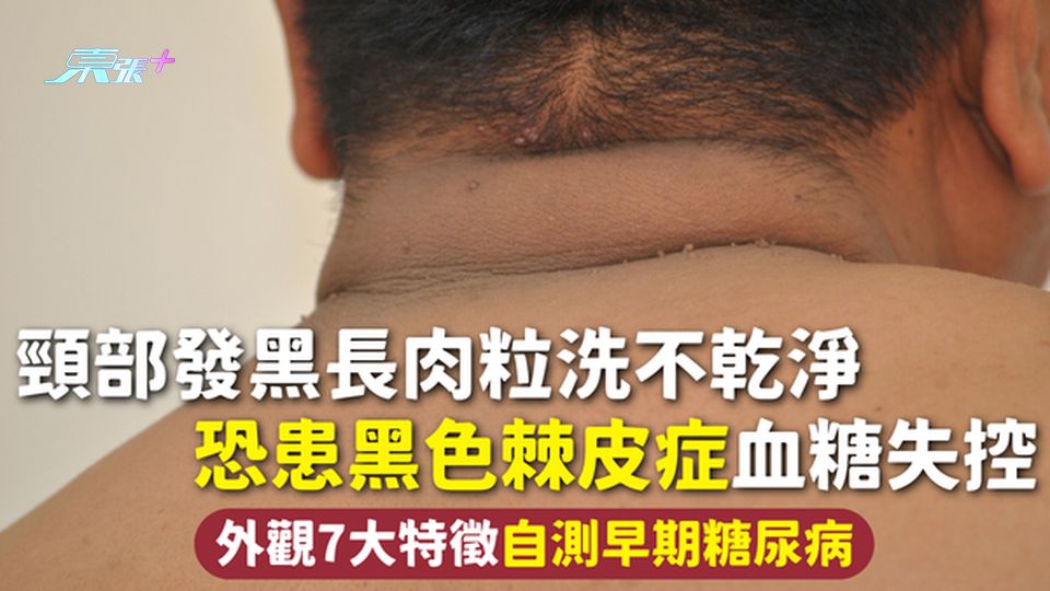 血糖 | 頸部發黑長肉粒洗不乾淨 恐患黑色棘皮症血糖失控 外觀7大特徵自測早期糖尿病