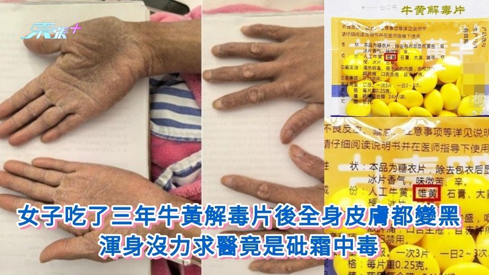 女子吃了三年牛黃解毒片後全身皮膚都變黑 渾身沒力求醫竟是砒霜中毒