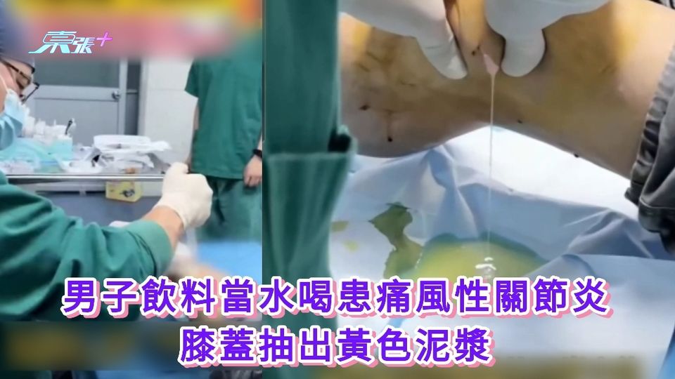 有片丨33歲男子飲料當水喝患痛風性關節炎 膝蓋抽出黃色泥漿
