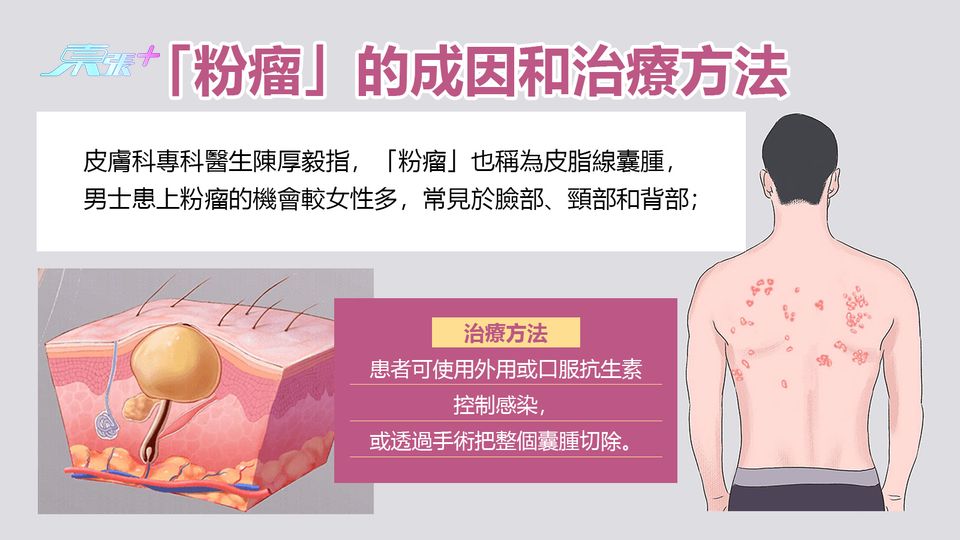 「粉瘤」的成因和治療方法