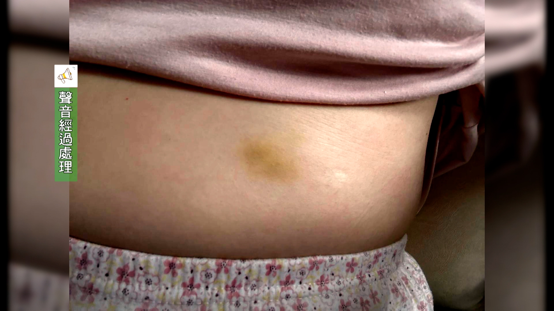 事主回家後，發現肋骨位置有瘀傷，而手部亦有痛楚。