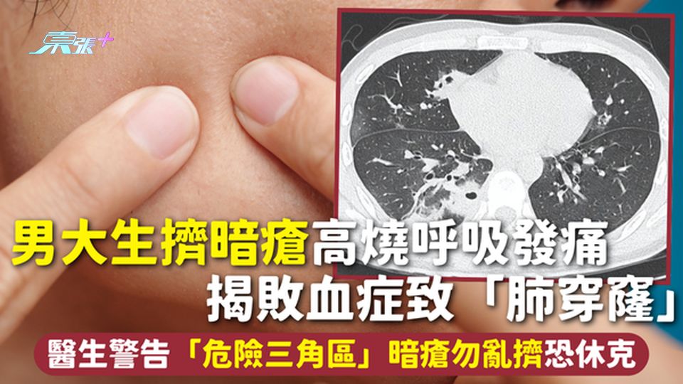 擠暗瘡 | 男大生擠暗瘡高燒呼吸發痛 揭敗血症致「肺穿窿」醫生警告「危險三角區」暗瘡勿亂擠恐休克