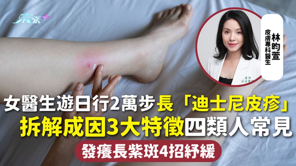 迪士尼皮疹｜女醫生遊日行2萬步長「迪士尼皮疹」拆解成因3大特徵四類人常見 發癢長紫斑4招紓緩