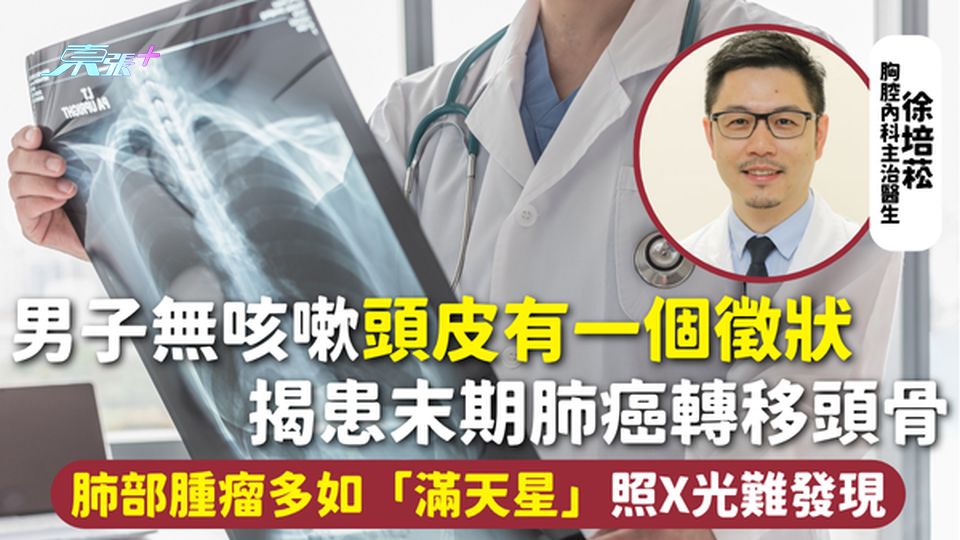 肺癌 | 男子無咳嗽頭皮有一個徵狀 揭患末期肺癌轉移頭骨 肺部腫瘤多如「滿天星」照X光難發現