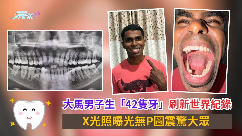 大馬男子生「42隻牙」刷新世界紀錄　X光照曝光無P圖震驚大眾