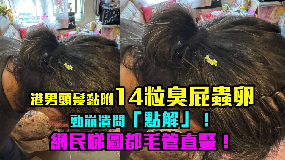 驚嚇相︱港男頭髮黏14粒臭屁蟲卵崩潰問「點解」！網民睇圖都毛管戙！