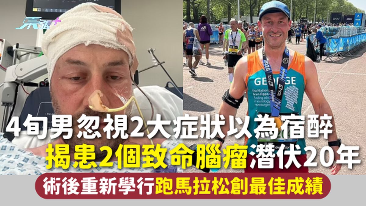 抗癌故事 | 4旬男忽视2大症状以为宿醉 揭患2个致命脑瘤潜伏20年 术后重新学行跑马拉松创最佳成绩