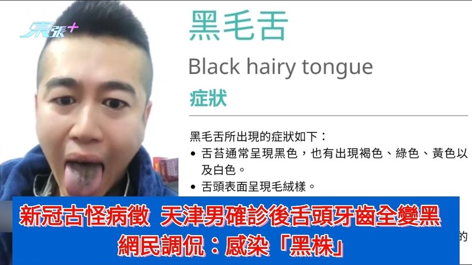 新冠古怪病徵 天津男確診後舌頭牙齒全變黑  網民調侃：感染「黑株」