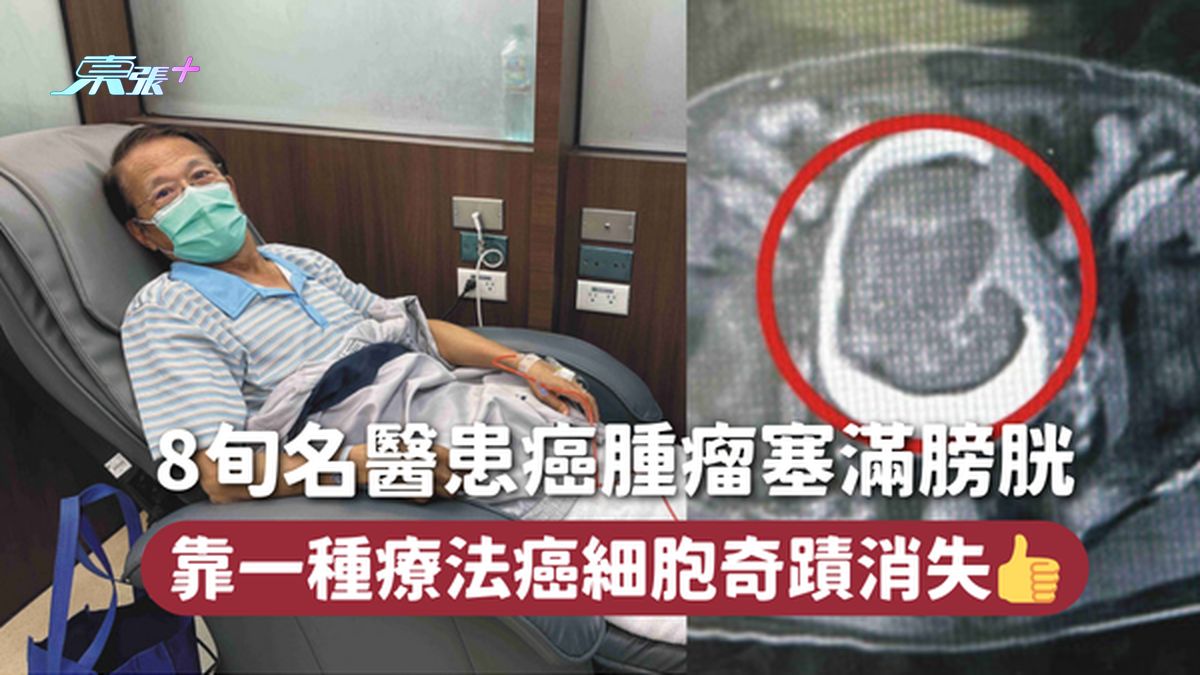 膀胱癌 | 8旬名医患癌肿瘤塞满膀胱 靠一种疗法癌细胞奇迹消失👍