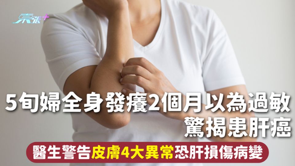 肝癌 | 5旬婦全身發癢2個月以為過敏 驚揭患肝癌 醫生警告皮膚4大異常恐肝損傷病變