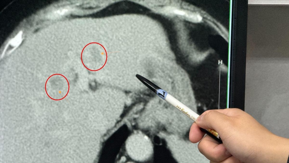 台中一名60多歲的婦人，太愛吃甜食、水果，導致重度脂肪肝進而罹患肝癌。（圖／大甲李綜合醫院提供）