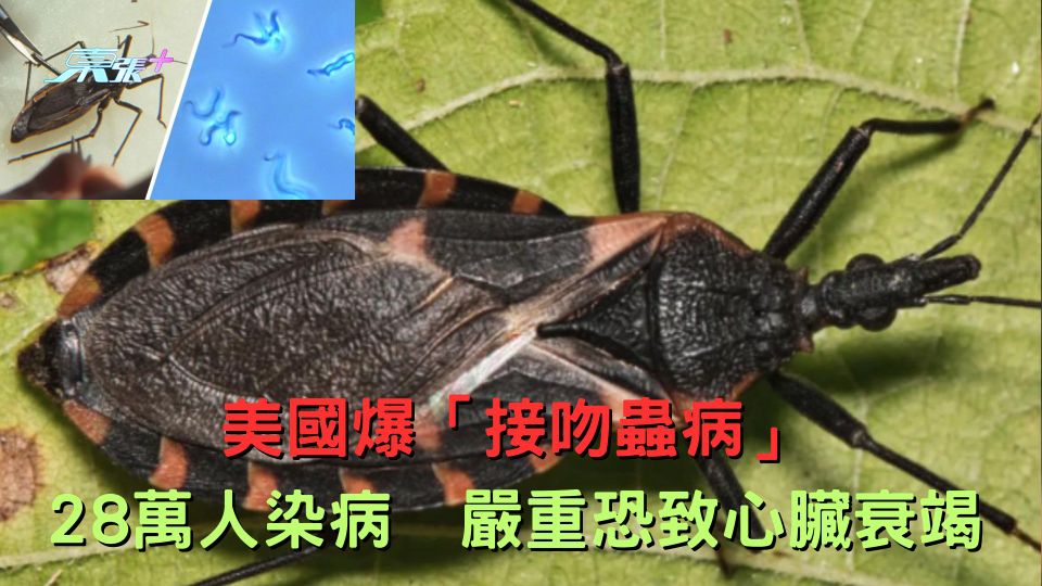 美國爆「接吻蟲病」 28萬人染病　嚴重恐致心臟衰竭