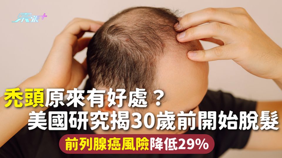 禿頭｜光頭原來有好處？美國研究揭30歲前開始脫髮 前列腺癌風險降低29%