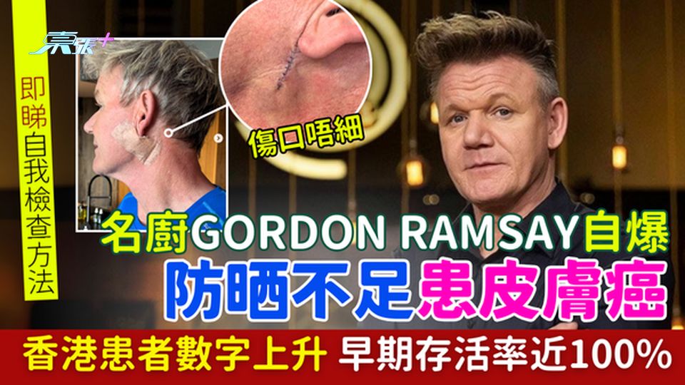 皮膚癌｜名廚Gordon Ramsay患皮膚癌 香港患者數字上升存活率近100% 即睇自我檢查方法