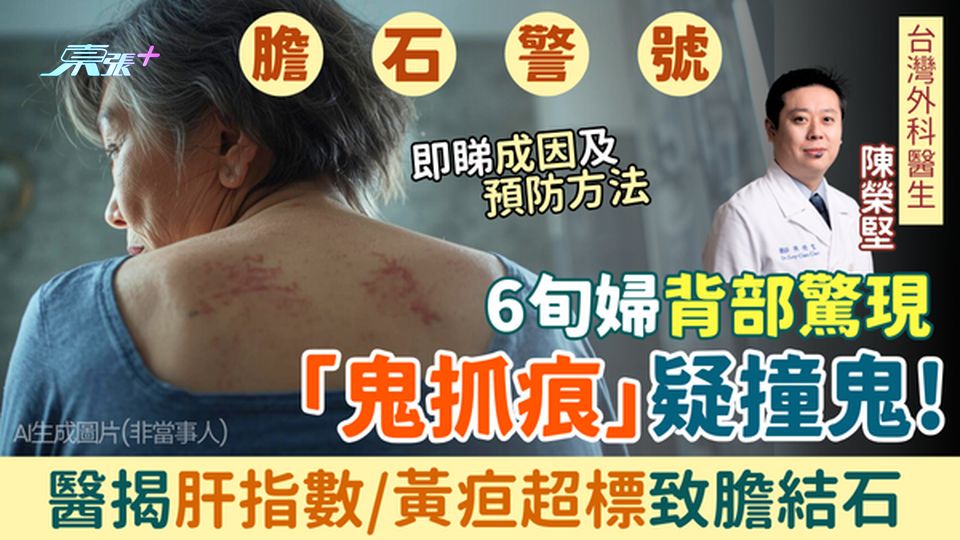 膽石警號｜6旬婦背驚現「鬼抓痕」疑撞鬼！ 醫揭肝指數黃疸超標致膽結石 即睇成因＋預防方法