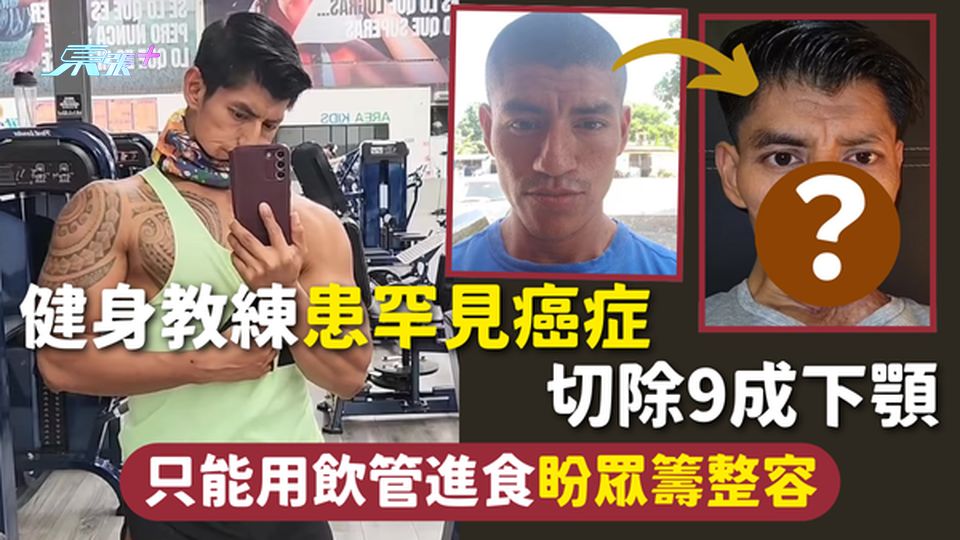 罕見病 | 健身教練患罕見癌症 切除9成下顎 只能用飲管進食盼眾籌整容