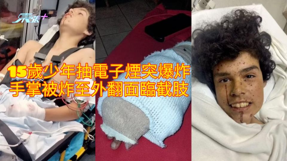 15歲少年抽電子煙突爆炸 手掌被炸至外翻面臨截肢