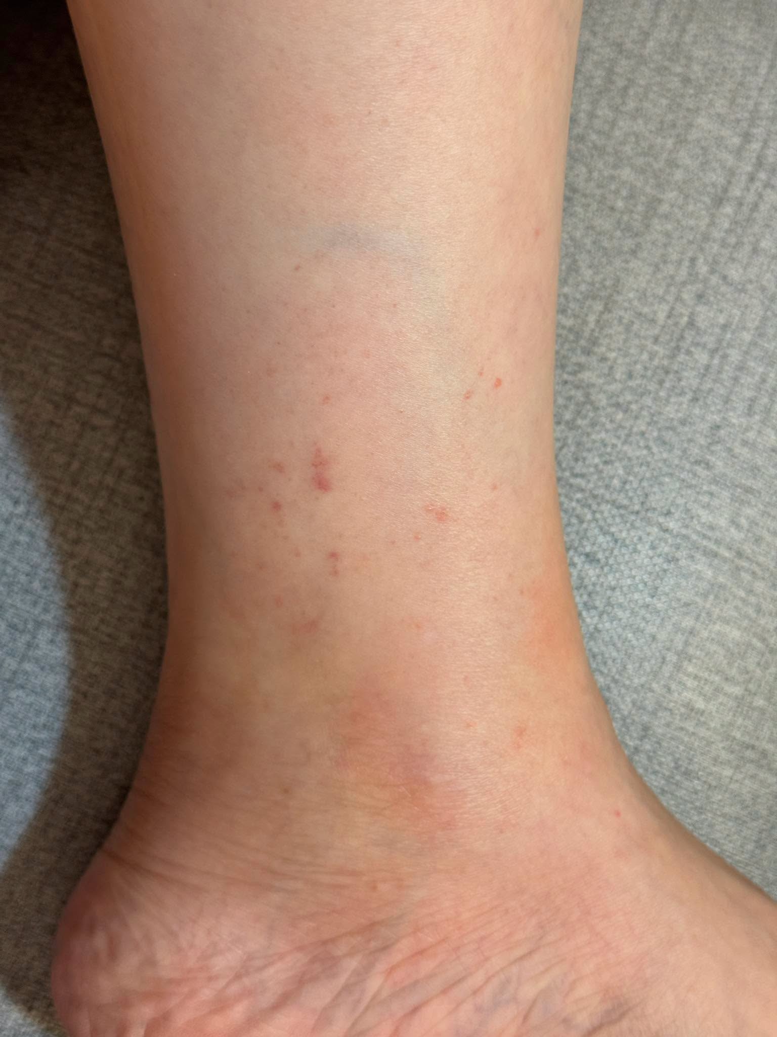 May be an image of acupuncture