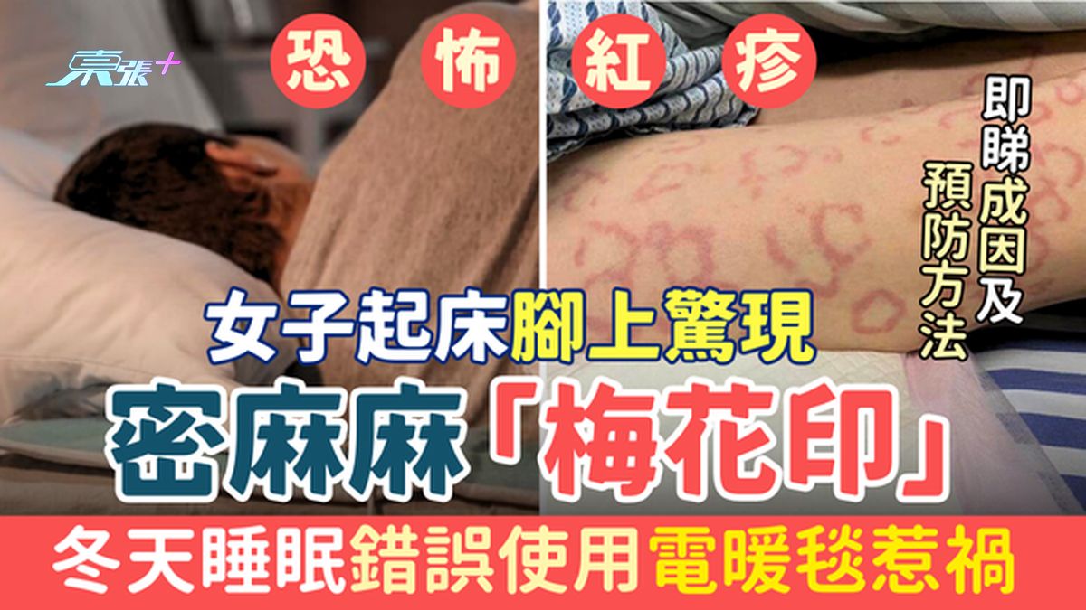 恐怖红疹｜女子起床脚上惊现密麻麻「梅花印」 医生揭冬天睡眠错误使用电暖毯惹祸