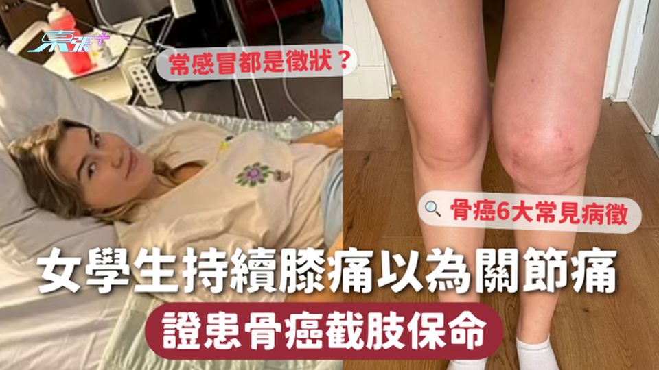 骨癌 | 女學生持續膝痛以為關節痛 證患骨癌截肢保命 常感冒都是徵狀？😷