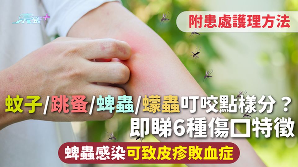 蚊蟲叮咬｜蚊子/跳蚤/蜱蟲/蠓蟲叮咬點樣分？即睇6種傷口特徵 蜱蟲感染可致皮疹敗血症 附患處護理方法