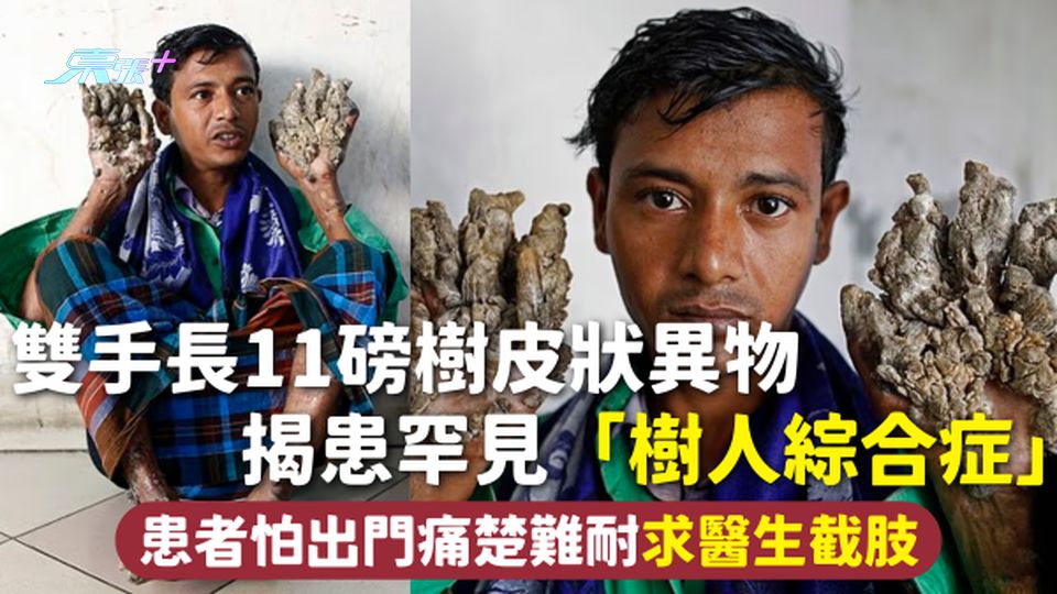 罕見病 | 雙手長11磅樹皮狀異物 揭患罕見「樹人綜合症」 患者怕出門痛楚難耐求醫生截肢