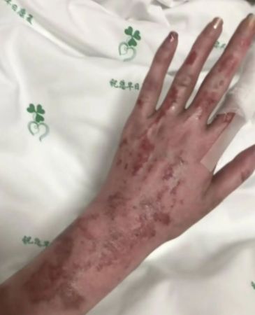 ▲▼27歲陸美妝網紅燒傷。（圖／翻攝自微博）