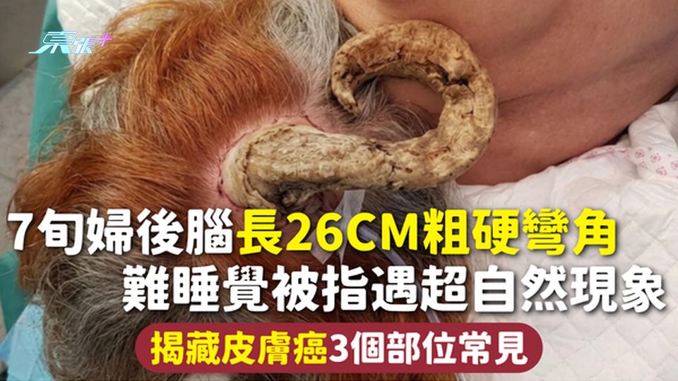 皮膚癌 | 7旬婦後腦長26cm粗硬彎角 難睡覺被指遇超自然現象 揭藏皮膚癌3個部位常見【有圖】