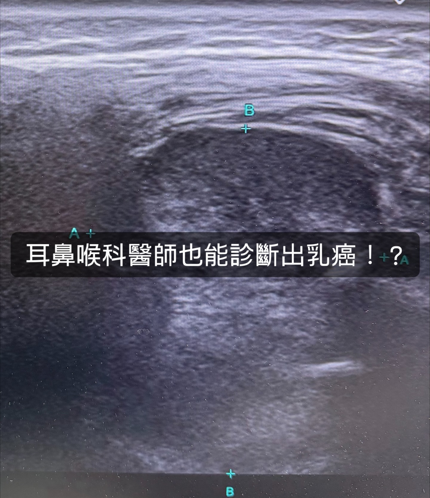 May be an image of xray and text that says '耳鼻喉科醫師也能診斷出乳癌！'