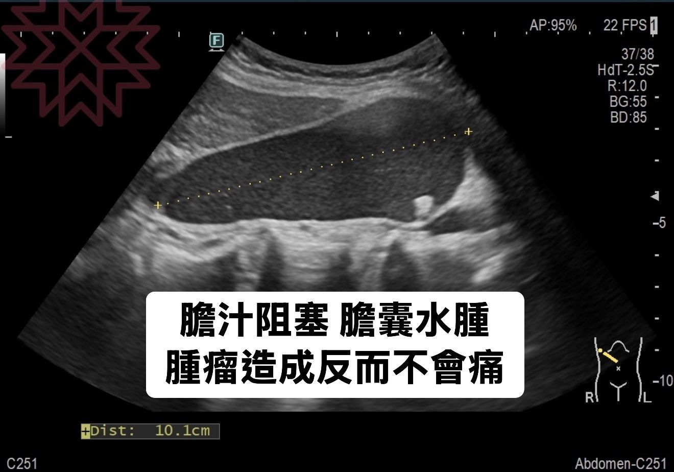 可能是 X 光和顯示的文字是「 F ,AP AP:95% 22 22FPS 37/38 38 37 HdT-2.55 55 HdT-2 R:12.0 BG:55 BG: BD:85 85 BD 膽汁阻塞 且塞膽囊水腫 腫瘤造成反而不會痛 +Dist:10.1cm 10. +Dist: 10.1cm 1cm C251 R F1 -10 Abdomen-C251 」的圖像