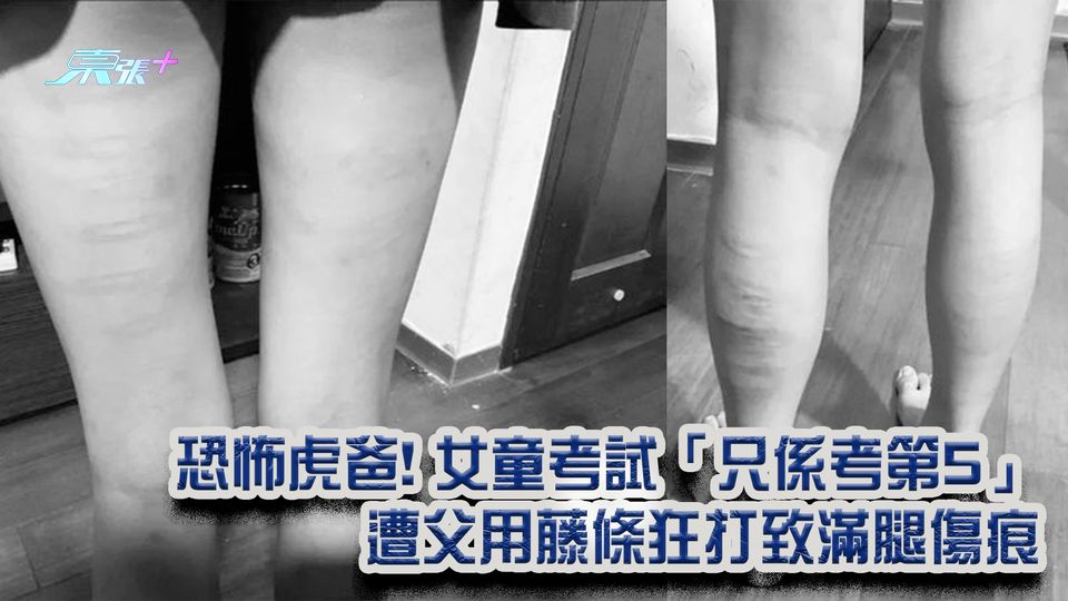 恐怖虎爸! 女童考試「只係考第5」 遭父用藤條狂打致滿腿傷痕