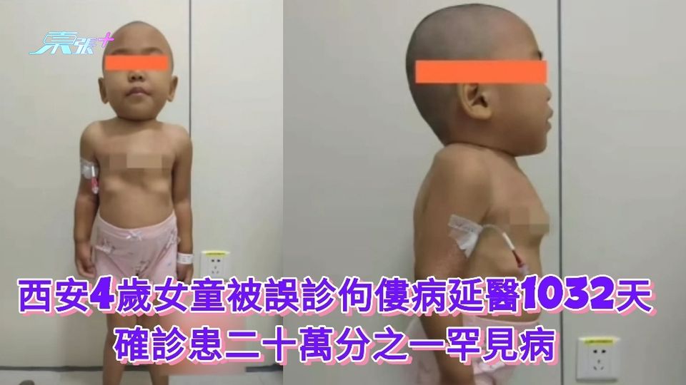 西安4歲女童被誤診佝僂病延醫1032天 確診患二十萬分之一罕見病