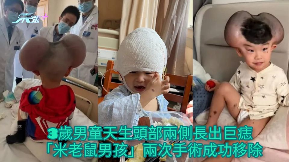 3歲男童天生頭部兩側長出巨痣 「米老鼠男孩」兩次手術成功移除