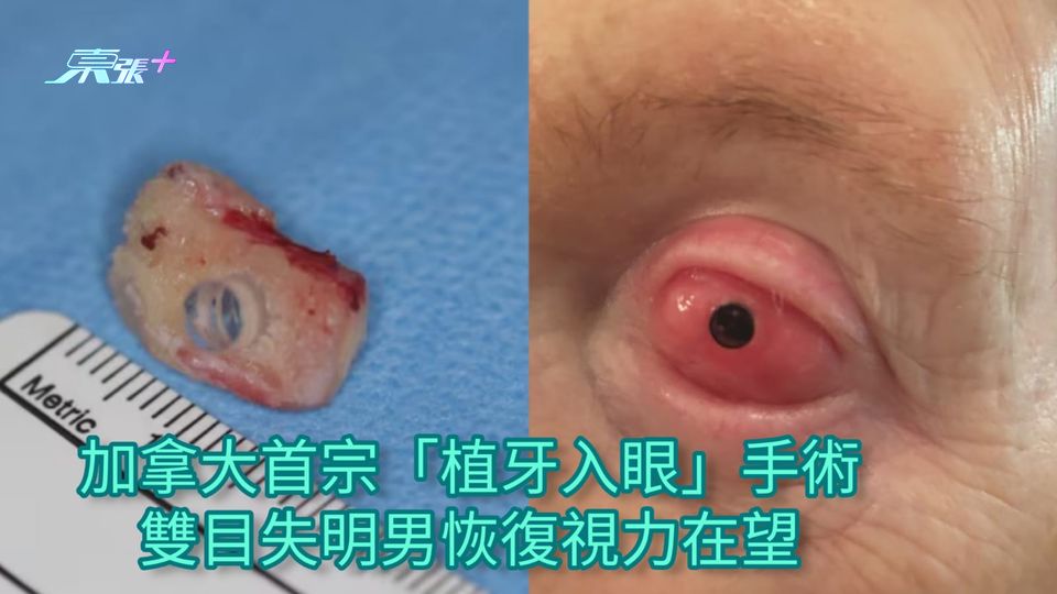 加拿大首宗「植牙入眼」手術 雙目失明男恢復視力在望