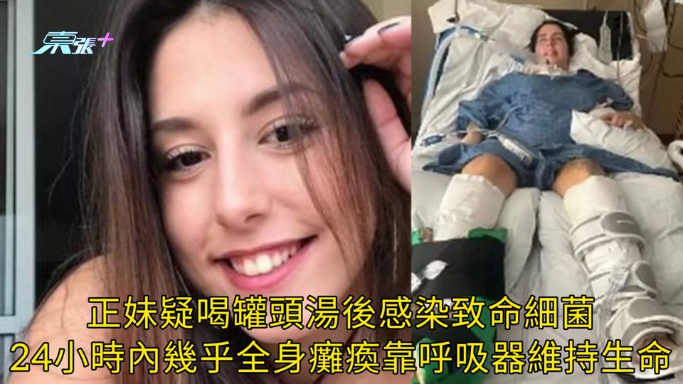 正妹疑喝罐頭湯後感染致命細菌 24小時內幾乎全身癱瘓靠呼吸器維持生命