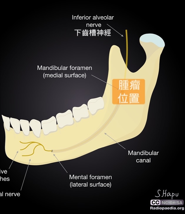 May be an image of xray, bone and text that says 'Inferioralveolar Inferior alveolar nerve 下齒槽神經 Mandibular foramen (medial (medialsurface) surface) 腫瘤 腫瘤 位置 ve nes Mandibular canal al nerve Mentalforamen Mental foramen (lateral (lateralsurface) surface) SHapu CC NC BY NCBYSA SA Radiopaedia.org'
