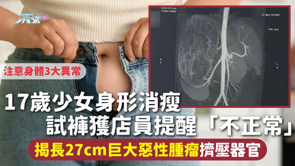 17歲少女身形消瘦 試褲獲店員提醒「不正常」 揭長27cm巨大惡性腫瘤擠壓器官 注意身體3大異常