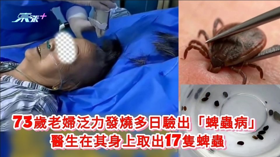 73歲老婦泛力發燒多日驗出「蜱蟲病」 醫生在其身上取出17隻蜱蟲