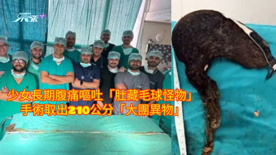 少女長期腹痛嘔吐「肚藏毛球怪物」 手術取出210公分「大團異物」