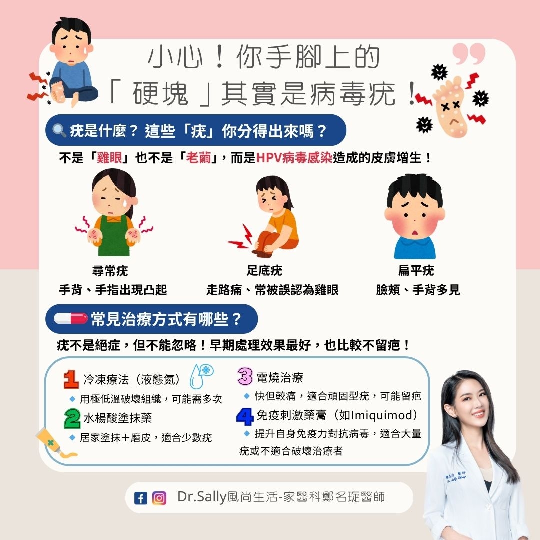May be an image of 1 person and text that says '小心！ 小心！你手脚上的 你手脚上的 硬塊」其實是病毒疣 疣是什麽？ 充是什麽？這些「琉」你分得出來嗎？ 這些 「疣」 你分得出來嗎？ 不是「想則」也不是「老前，而是Pい病青感染這成的皮商對生！ 不是 「雞眼」 也不是 「老蕭」， 而是HPV病毒感染造成的皮應增生 足底疣 走路痛 路痛、常被誤認為雞眼 尋常疣 手背、手指出現凸起 手背、 常見治療方式有哪些？ 疣不是絕症， 但不能忽略 早期處理效果最好 扁平疣 臉頰 、手背多見 也比較不留疤 冷凍療法（液態氣） 冷凍療法 （液態氨) 用極低溫破壞組織 可能需多次 水楊酸塗抹藥 居家塗抹+陸 居家塗抹+磨皮，適合少数充 磨皮 適合少数疣 3 3雷焼治療 快但較痛 ，適合頑固型疣 可能留疤 免疫刺激藥膏 免疫刺激藥膏（如lmiguimod) (lmiquimod) 提升自身免疫力對抗病秀， 適合大量 疣或不適合破壞治療者 f Dr.al風尚生活-家醫科鄭名短警師 Dr.Sally'