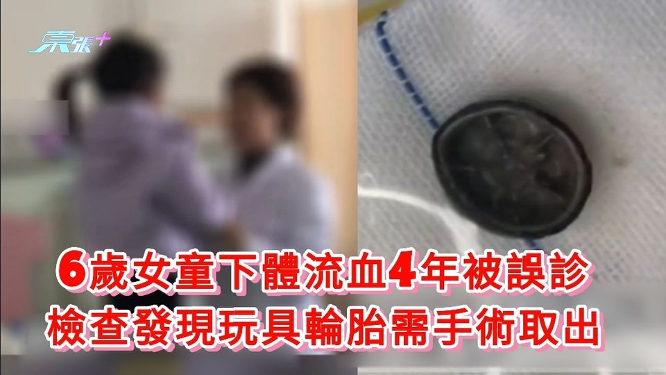 6歲女童下體流血4年被誤診 檢查發現玩具輪胎需手術取出