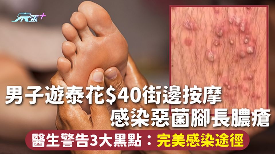 按摩小心 | 男子遊泰花$40街邊按摩 感染惡菌腳長膿瘡 醫生警告3大黑點：完美感染途徑