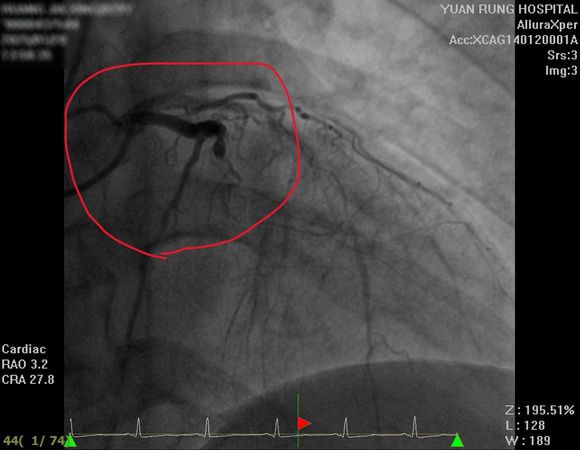 ▲▼29歲患者因高血壓未服藥，加上生活作息不正常，心臟三根動脈血管都嚴重阻塞。（圖／員榮醫院提供）